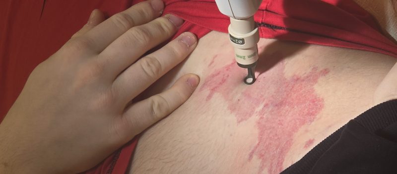 Laser na naczynka - Platforma Laserowa w Krakowie